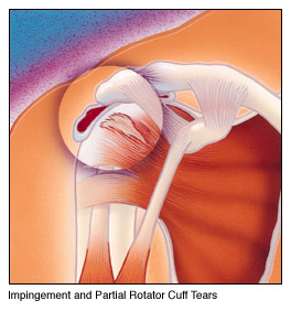 shoulder impingement