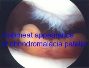 chrondromalacia patella